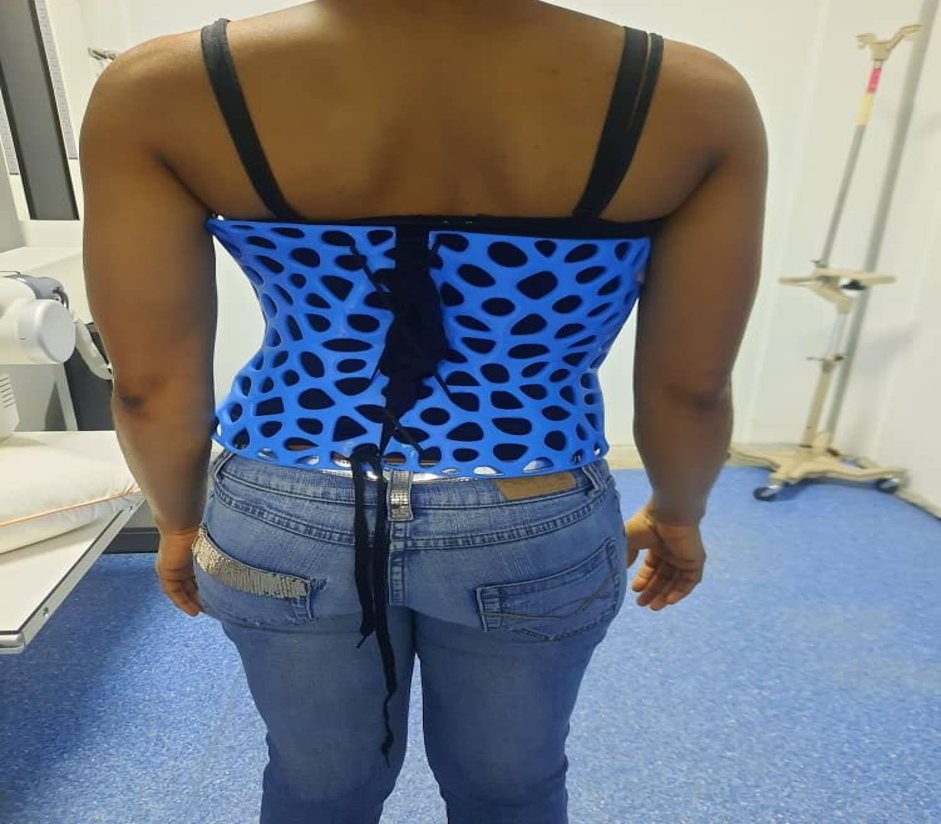 Customized 3D-printed thoracic scoliosis brace worn by a subject